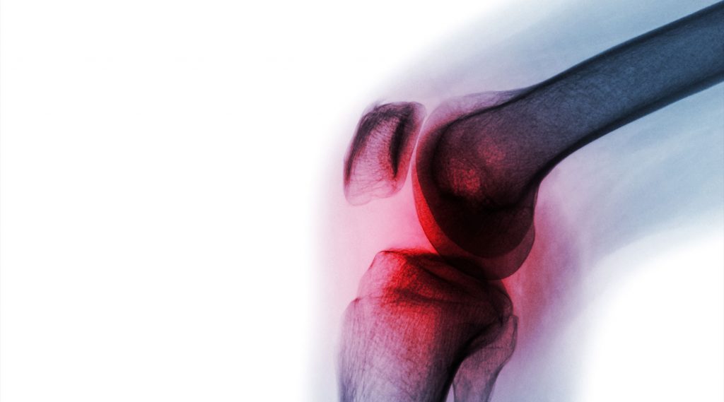 CAG ROAD, transparant knæ, røde knogler, gråt ben, hvid baggrund