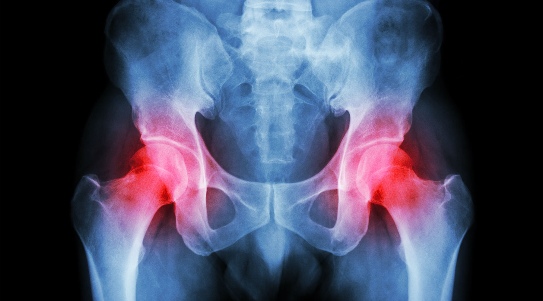 Webinar om moderne behandling af hofteartrose